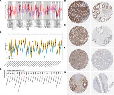 High Expression of SLC16A1 as a Biomarker to Predict Poor Prognosis of Urological Cancers